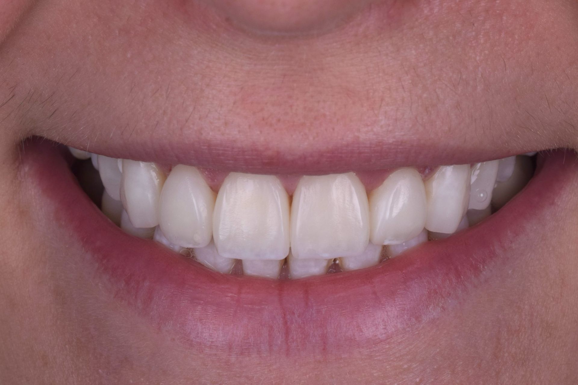 Reshaped smile after composite bonding treatment
