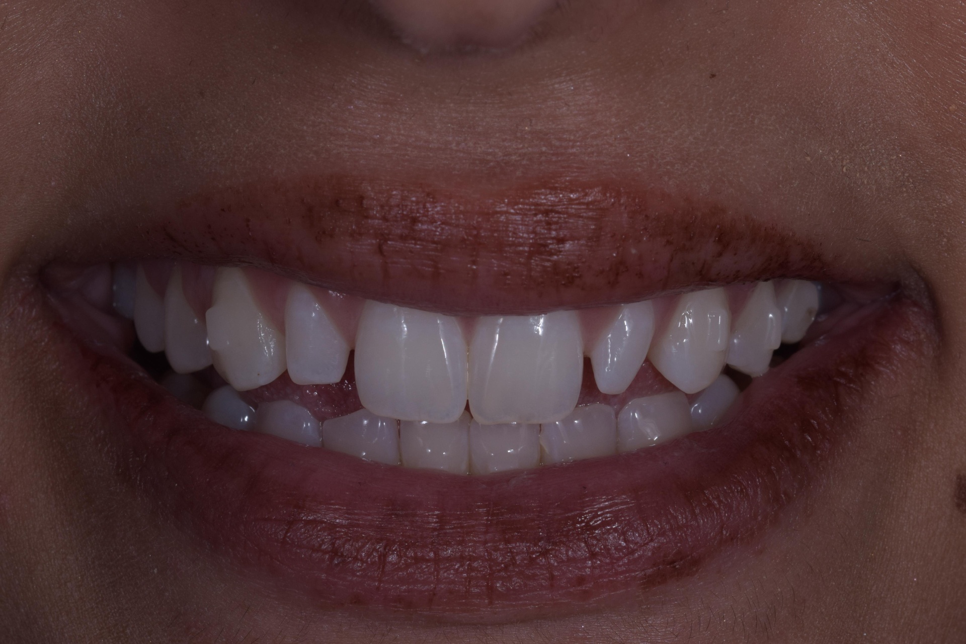 Patient smile before composite bonding treatment