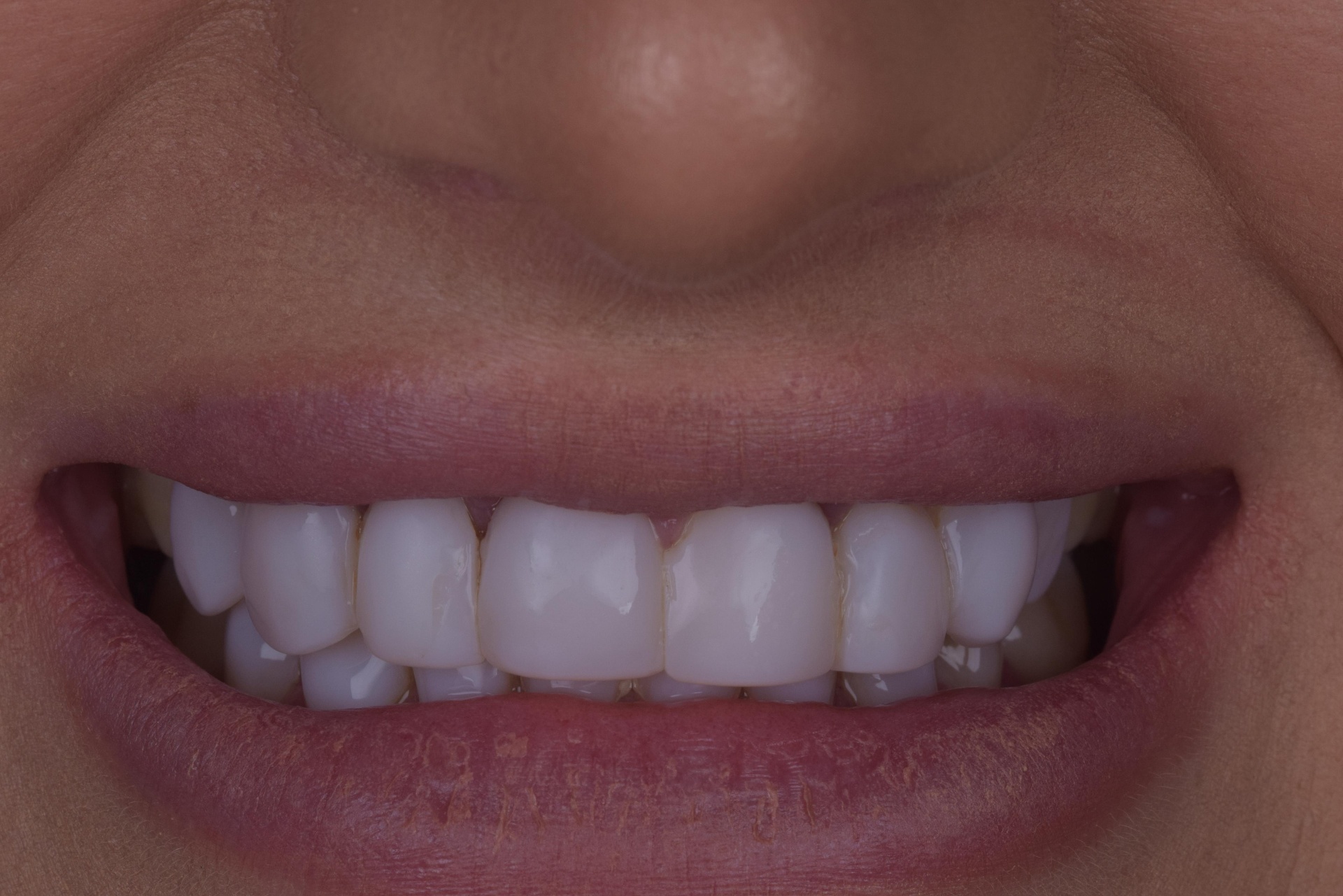 Patient smile before composite bonding treatment