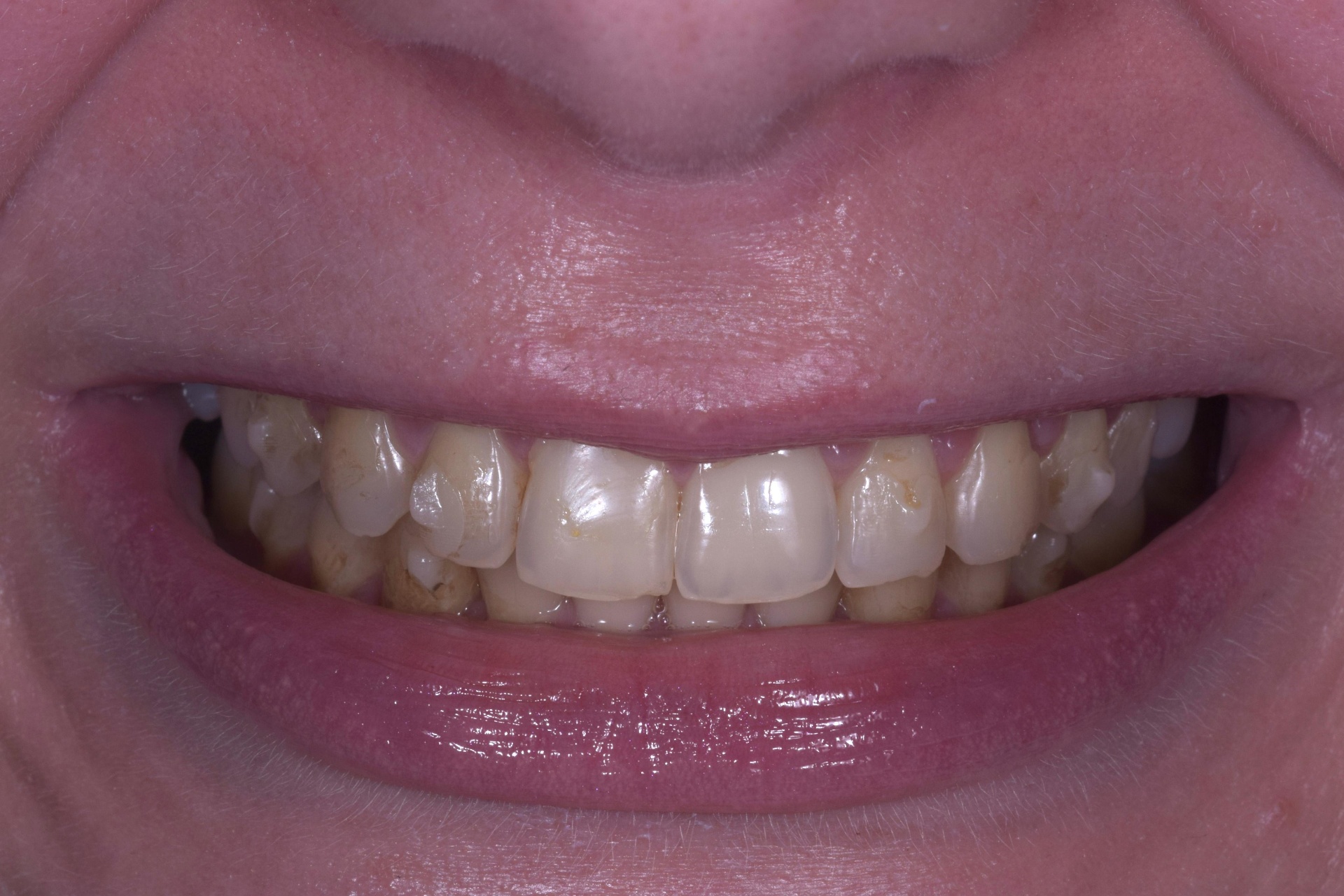 Patient smile before composite bonding treatment
