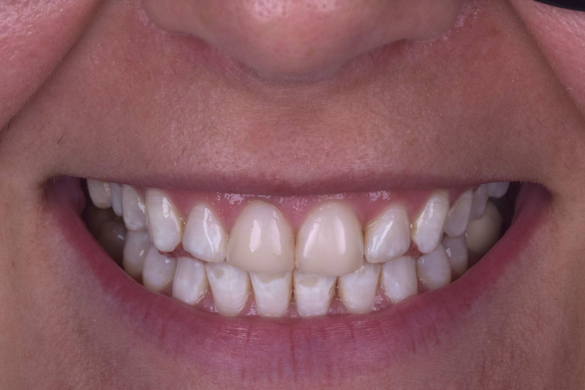 Patient smile before composite bonding treatment