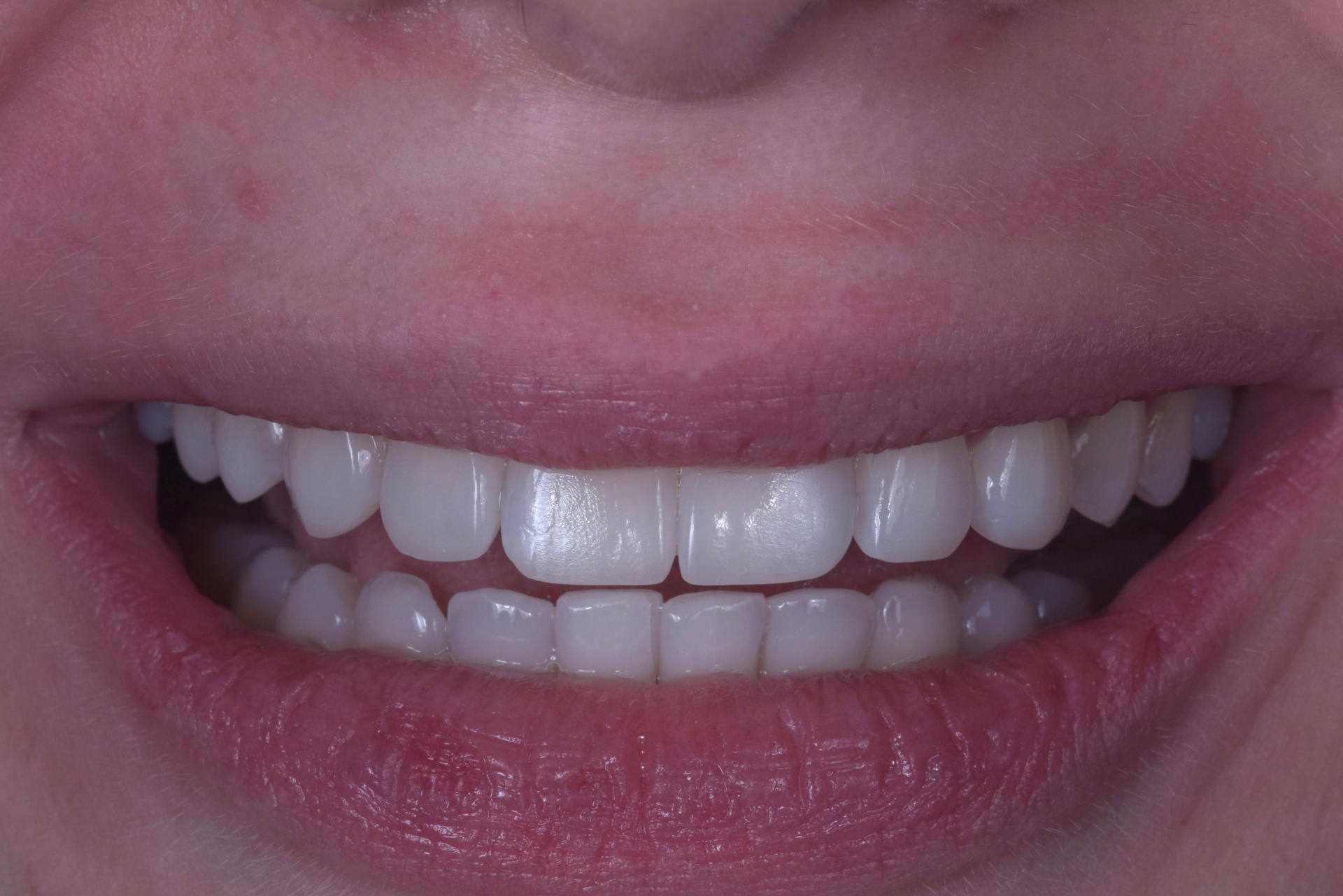 Reshaped smile after composite bonding treatment