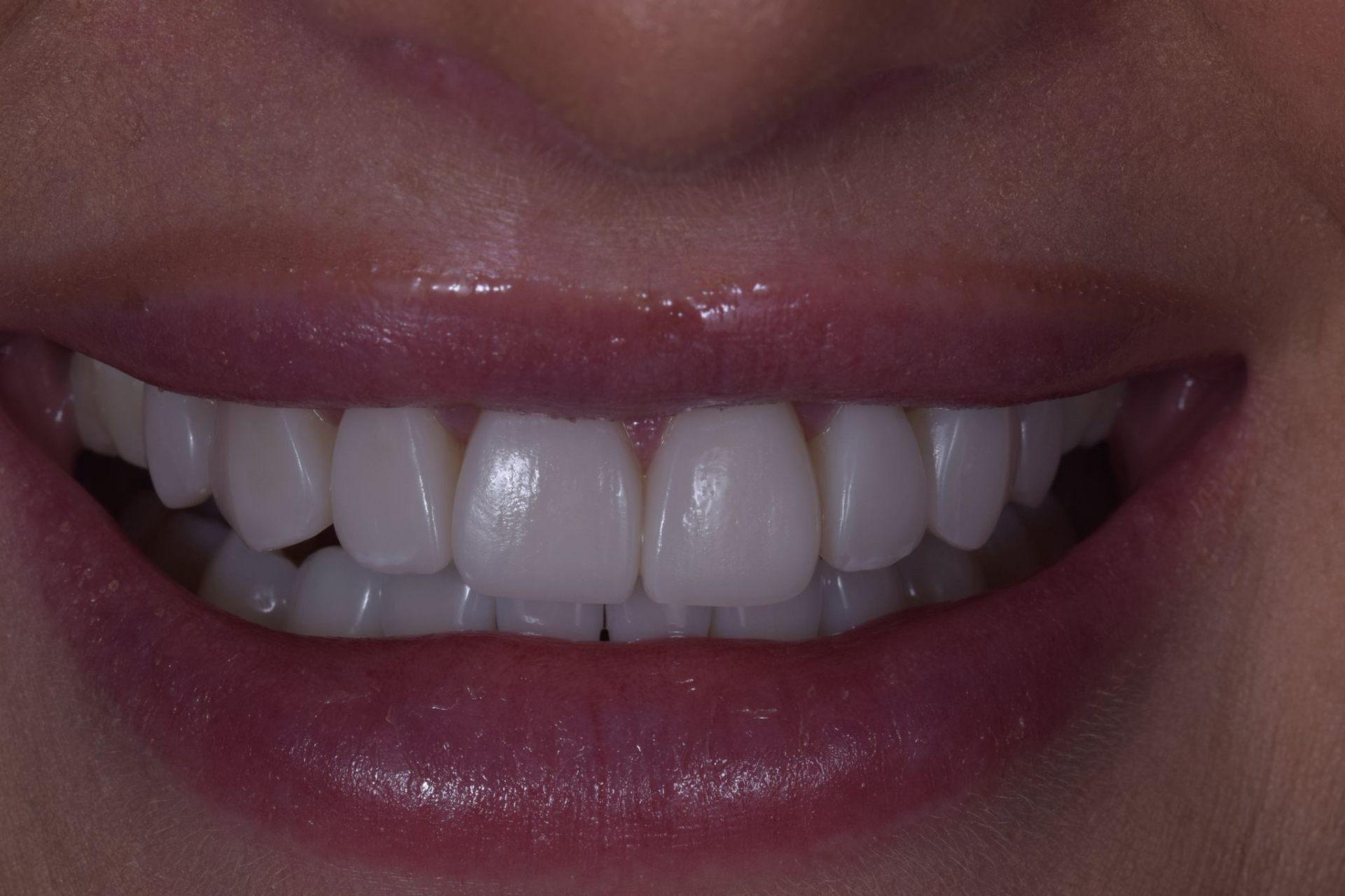 Reshaped smile after composite bonding treatment