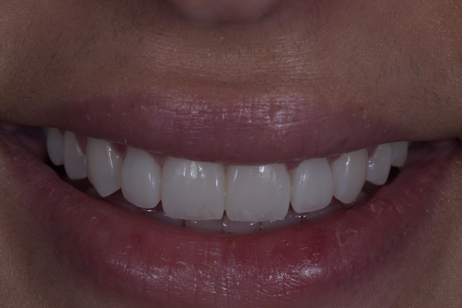 Reshaped smile after composite bonding treatment